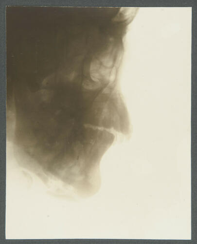 4. Sepoy Pagat Singh, 107th Pioneers. [Indian Army: radiographs of wounds, 1914-1915]