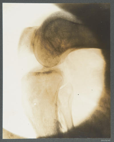 11. Sepoy Rudh Singh, 59th Rifles. [Indian Army: radiographs of wounds, 1914-1915]