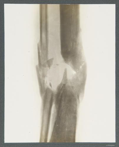 9. Rifleman Kirtabir Thapa, 2/2 Gurkhas. [Indian Army: radiographs of wounds, 1914-1915]