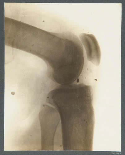 12. Rifleman Kabiram Thapa, 2/8 Gurkhas. [Indian Army: radiographs of wounds, 1914-1915]