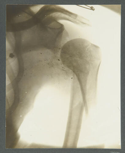 6. Jemadar Arbhan Thrapa, 2/2 Gurkhas. [Indian Army: radiographs of wounds, 1914-1915]