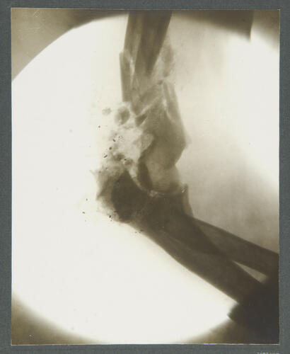5. Rifleman Dhir Behadur Thapa, 2/2 Gurkhas. [Indian Army: radiographs of wounds, 1914-1915]